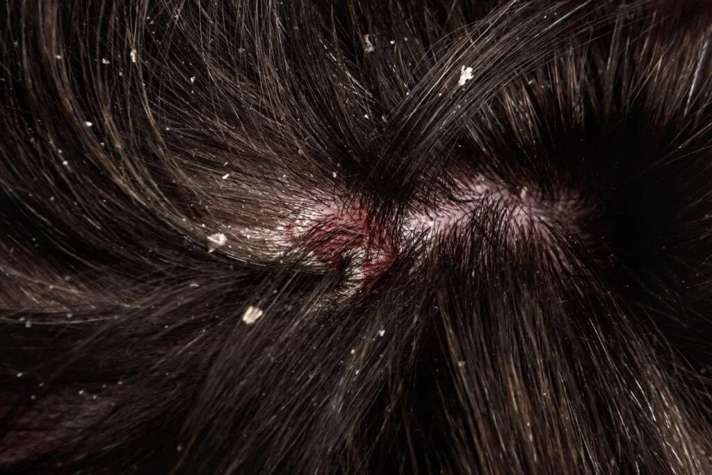 des pellicules sur le cuir chevelu d'une femme